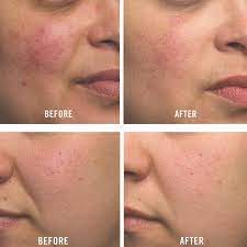 27 Redness-Reducing Products That Actually Work