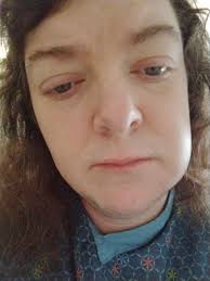 Severe Tooth Infection and Hospitalization Experience