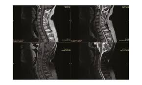 The syndrome often follows infection with a virus or bacteria — and on very rare occasions it can follow a vaccination. Unilateral Facial Palsyin Guillain Barre Syndrome A Hyperreflexic Variant Case European Medical Journal