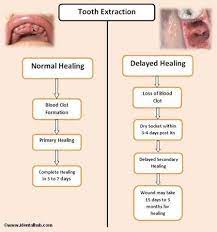 Tooth Extraction Aftercare Tooth Extraction Aftercare Tooth Extraction Care Dentistry