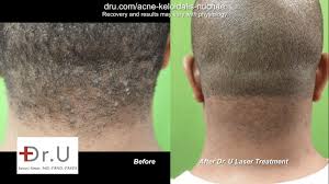 Ingrown hair on the head might sometimes look like tiny red skin bumps. Haircut Bumps On Back Of Head Novocom Top