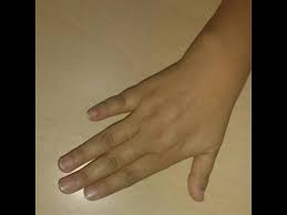 Having a crroked pinky means you, most likely need medical treatment. Your Little Finger Reveals How Secretive You Are Boldsky Com