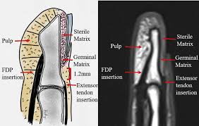 Most jersey finger repair techniques involve reattaching the tendon to an approximate location corresponding to the tendon's native attachment. Management Of Tendon And Bony Injuries Of The Distal Phalanx Hand Clinics