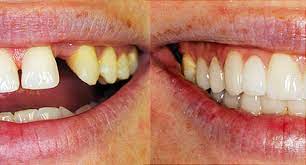 Before sharing sensitive information, make sure you're on a federal government site. Cosmetic Dentistry Before And After Pictures