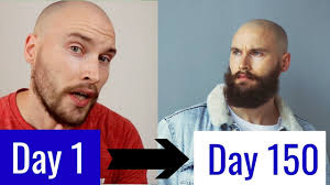 These are real before and after photos of real guys before applying minoxidil their faces and after using it for a period of time in order to grow their beards. 5 Month Minoxidil Beard Transformation Youtube