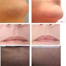 If your body makes too much of this hormone, you may have unwanted hair growth. Unwanted Or Excessive Hair Growth