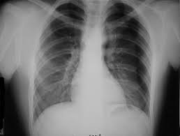 Image result for Chest Trauma