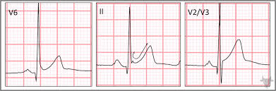 Image result for Early Repolarization