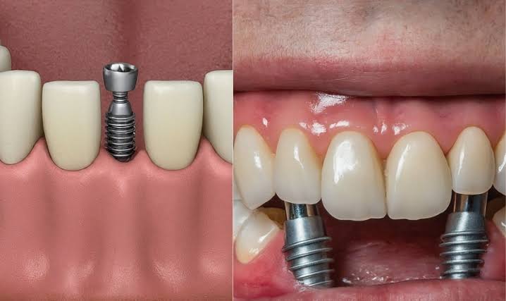 A Guide to Different Types of Dental Implants
