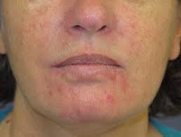 Erupciones faciales - Hoogstra - Centros Medicos