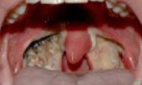 Post Tonsillectomy Hemorrhage