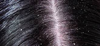 Dandruff signs and symptoms may include: Dandruff A Difficult Health Problem To Get Rid Of Tenerife News Official Website Tenerife News Official Website