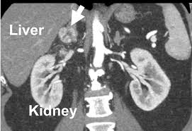 Kidney cancer, also called renal cell carcinoma, has many different forms, such as clear cell (the most how many patients have you treated with kidney cancer? Overview Of Adrenal Metastasis