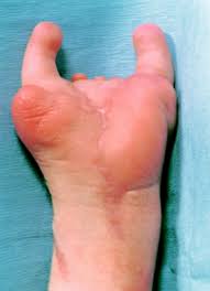 Poland syndrome is a complex genetic deformity in which the chest muscle is underdeveloped or absent. The Principles Of Management Of Congenital Anomalies Of The Upper Limb Archives Of Disease In Childhood