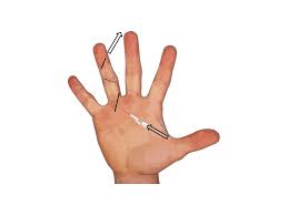 Image result for phlegmon of hand)