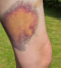Rotator cuff injuries cause pain in your shoulder and upper arm. Common Thigh Injuries My Family Physio