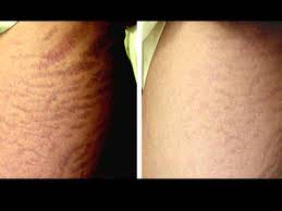 Bio Oil Results On Stretch Marks Before And After Derma Roller For Stretch Marks Before After Results Derma Roller Derma Roller Stretch Marks Skin Needling