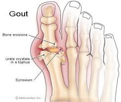 Foot Care In Connecticut Got Gout Holiday Season Triggers Painful Toes Home Remedies For Gout Gout Remedies What Is Gout