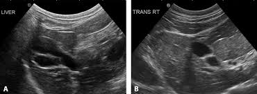 Removing the tumor and any associated cancerous cells is the best and most successful method of treating liver and spleen cancer. Imaging Essentials Small Animal Abdominal Ultrasonography