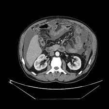 Studding the peritoneum and serosa of the small bowel at surgery. Malignant Peritoneal Mesothelioma Radiology Reference Article Radiopaedia Org