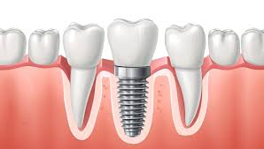 Image result for dental implant