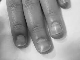 Image result for Muehrcke Line