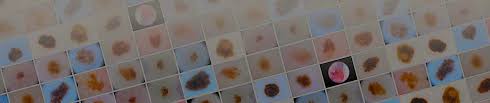 When cancerous tumors form on connective tissues, it is a sarcoma. Siim Isic Melanoma Classification Kaggle