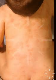 Image result for Urticaria pigmentosa children