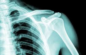 Image result for Shoulder XRay