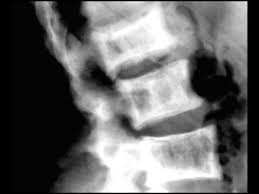 Pagets Disease Of The Lumbar Spine On X Ray Youtube