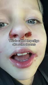 Image result for yellow scabs on the face in children