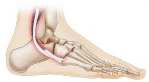 Usually, this is when the foot is forced up and to the side (for example, a caught ski tip.) causes of peroneal tendon injuries Peroneal Tendon Injuries Diagnosis Treatment Mammoth Lakes Ca