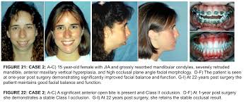Total Temporomandibular Joint Tmj Replacement Larry M Wolford Dmd