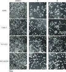 It can also be seen on computed tomography scans or chest radiographs. Alkaloids 1 And 4 Treatment Of Human Lung Cancer Cells At 10 Mm For 72 H Download Scientific Diagram