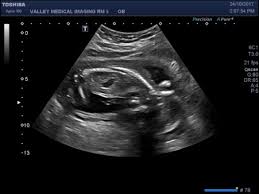 The newborn cannot show where it aches, and what exactly. Fluid In Babies Stomach At 19 Wk Ultrasound March 2018 Birth Club Babycenter Canada