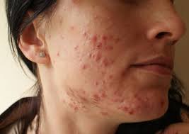 Image result for demodex rosacea
