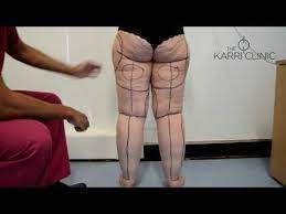 Live Surgery Liposuction For Type Iv Stage Ii Lipoedema By Mr Vasu Karri Before After Images Youtube Lipedema Liposuction Tumescent Liposuction