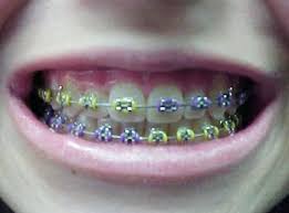 Im Pinterested In Braces This Is The Style I Like To Put On Boys Dental Braces Braces Colors Teeth Braces