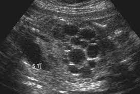 Fetal Mri Polycystic Kidney Disease