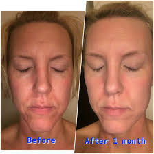 Pin On Fast Results Wrinkles Antiaging Acne Acne Scars Sunspots Rosacea Eczema Pores Skin Face Retinol