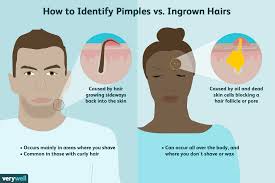 Typically found where a hair follicle emerges from the surface of the skin, razor bumps can sometimes be mistaken for acne. Difference Between A Pimple And An Ingrown Hair