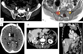 Early staging systems reflected mainly the experiences of individual. Radiological Evaluation Of Malignant Pleural Mesothelioma Defining Distant Metastatic Disease Bmc Cancer Full Text