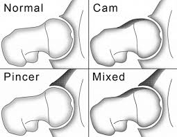Image result for Hip Labral Tear