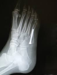 Patient may be in a removable boot after surgery for a week or two at the direction of the physician. Jones Fracture Faqs