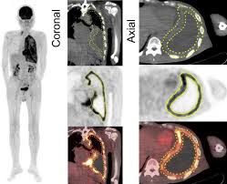 Mesothelioma is cancer of the lining that covers most of the body's organs. Development Of A Novel Prognostic Risk Classification System For Malignant Pleural Mesothelioma Clinical Lung Cancer