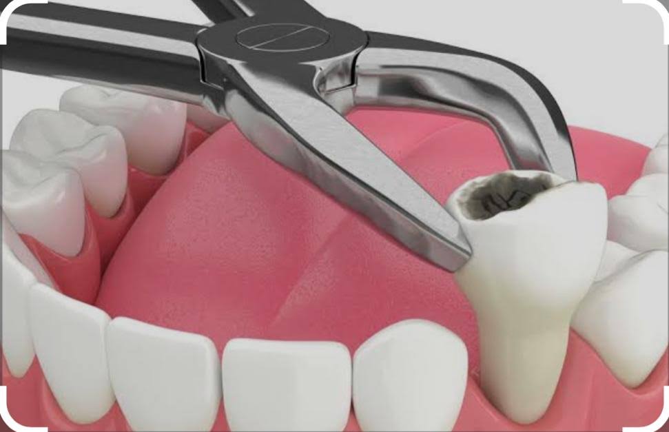 EXTRACTION product image