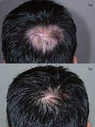 Questionnaires hair loss histories seem to lend themselves easily to questionnaires, which can this term also distinguishes between the frontal and vertex scalp hair loss that is seen in women and the. A Vertex Area Before Treatment B After 4 Months Of Multimodal Download Scientific Diagram