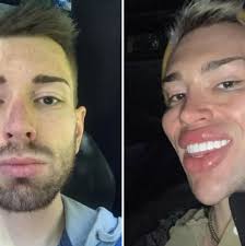 Ken Humano' remove mais de R$ 500 mil em plásticas: 'não sou ninguém'