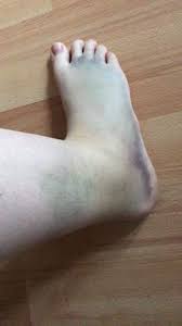 Gleich nach dem umknicken ist es wichtig, richtig zu handeln. Knochel Verstaucht Schwellung Verstauchung Umgeknickt