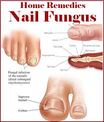 Home Remedies For Nail Fungus Nail Fungus Remedy Toenail Fungus Remedies Toenail Fungus